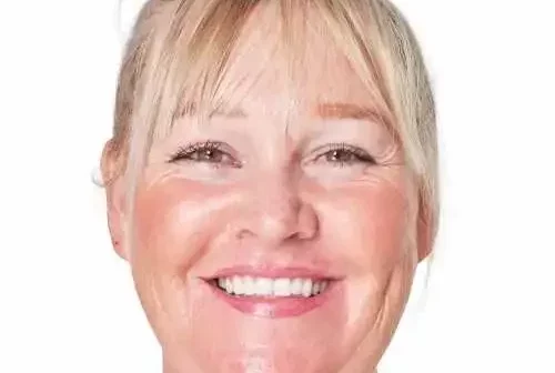 rosácea piel madura rojeces en mejillas