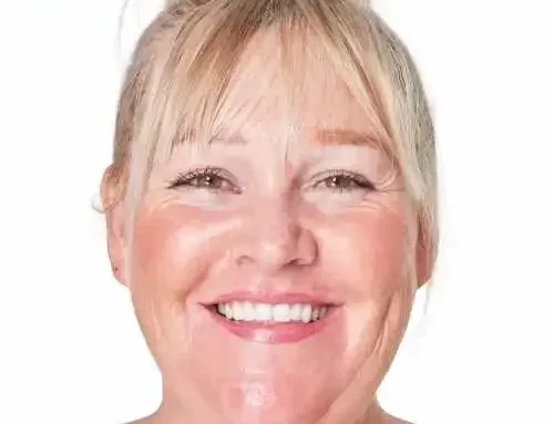 Rosácea en piel madura: entender las rojeces para cuidar mejor tu piel