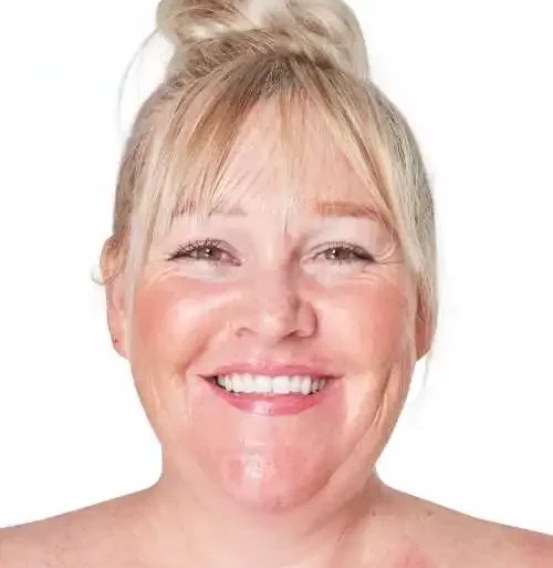 rosácea piel madura rojeces en mejillas