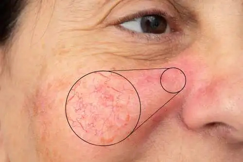 cuperosis y rosácea en piel madura